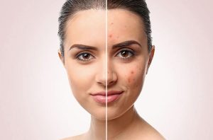 چگونه از پوست چرب مراقبت کنیم؟ بدون تحریک جوش